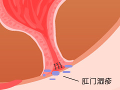 肛门湿疹要怎么预防