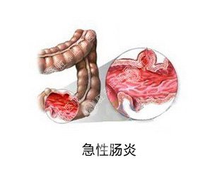 急性肠炎的病因是什么