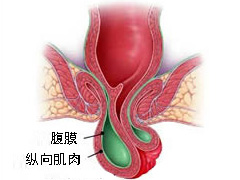 脱肛的较新治疗方法